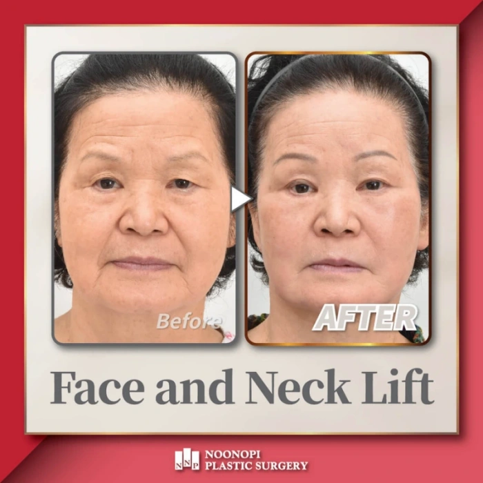 حالة شد الوجه والرقبة والحاجب