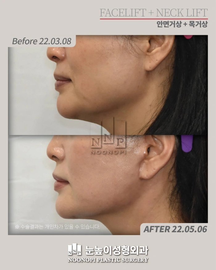 high SMAS facelift