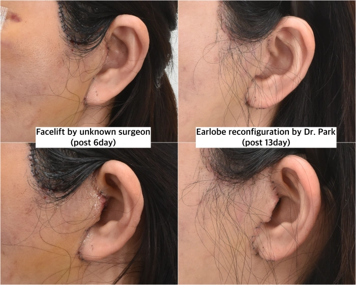 ear deformity reconstruction with revision facelift
