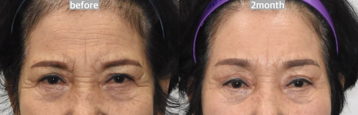 مريض بعد عملية رفع الحاجب مع بقاء خطوط دقيقة بين الحاجبين