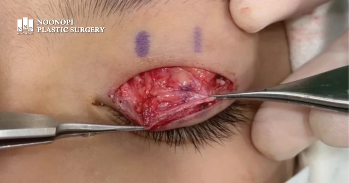 التنكس الدهني للعضلة الرافعة في حالة تدلي الجفن الخلقي