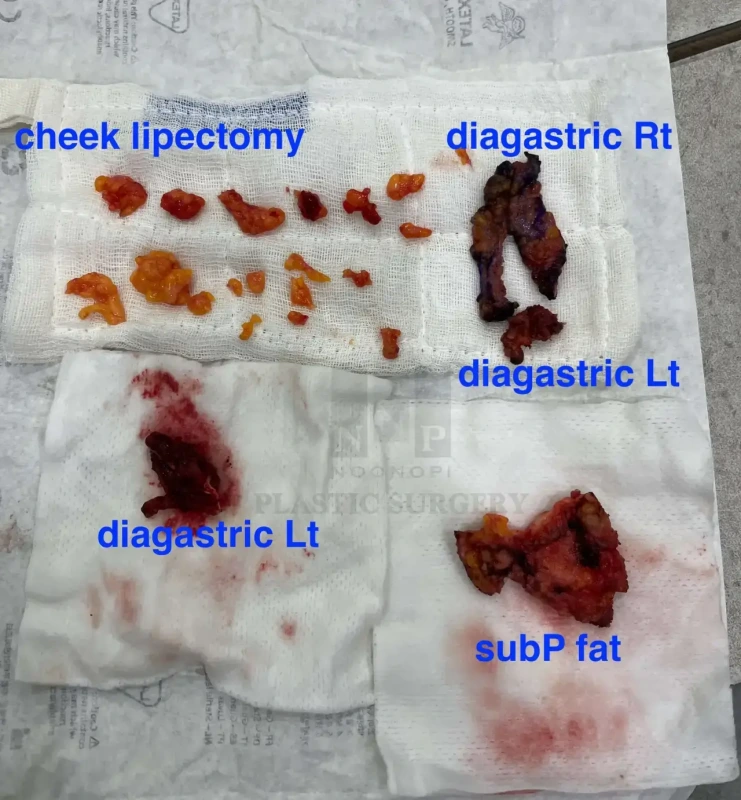 Removed tissue during Neck lift from Noonopi