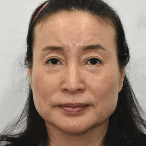 面部提升与颈部提升术后3个月效果