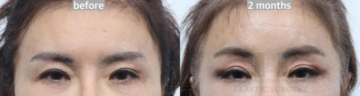 韩国内窥镜额部提升术