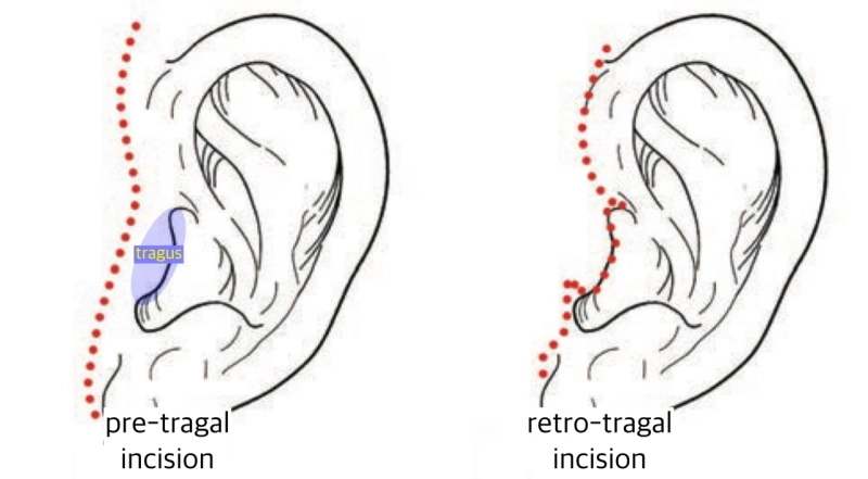 耳周两种切口类型