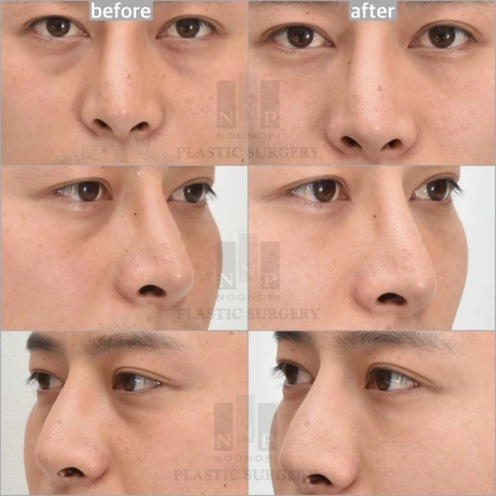 4 أشهر بعد علاج الهالات السوداء