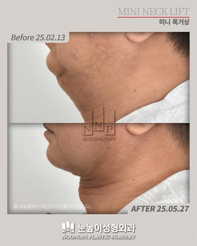 neck liposuction korea before after