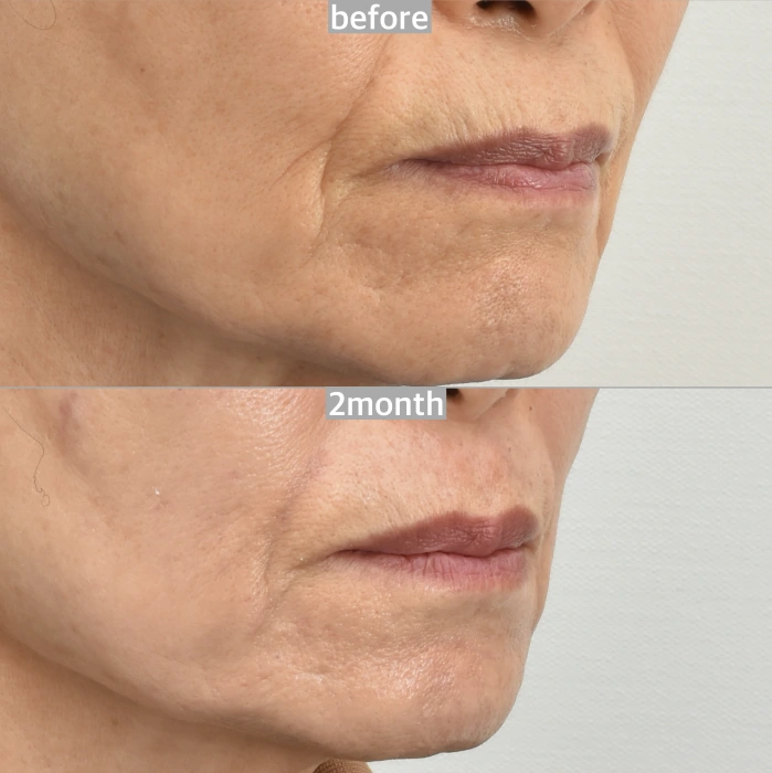 تجديد الكولاجين بعد الليزر لتقليل التجاعيد