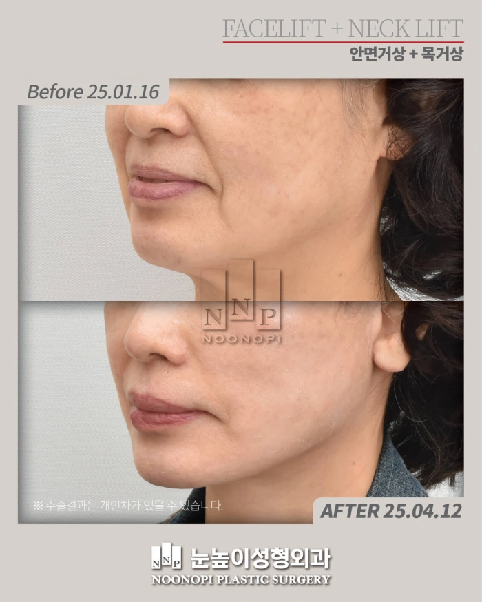 deep plane facelift before after korea