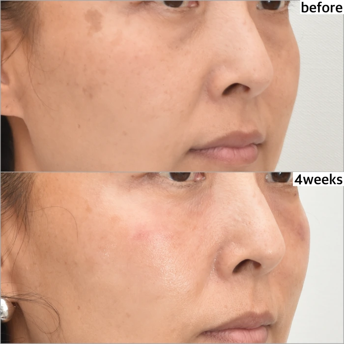 激光皮肤紧致与无创下睑成形术后4周