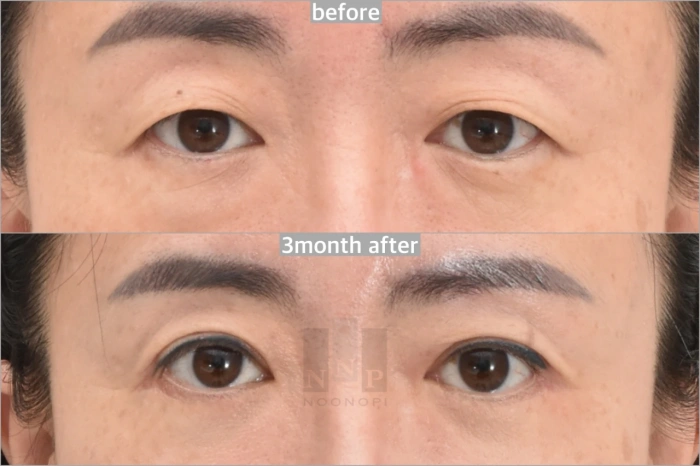 upper lower bleph 3months after