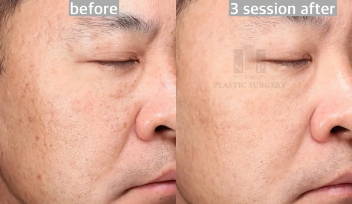 BBL HERO improves skin texture