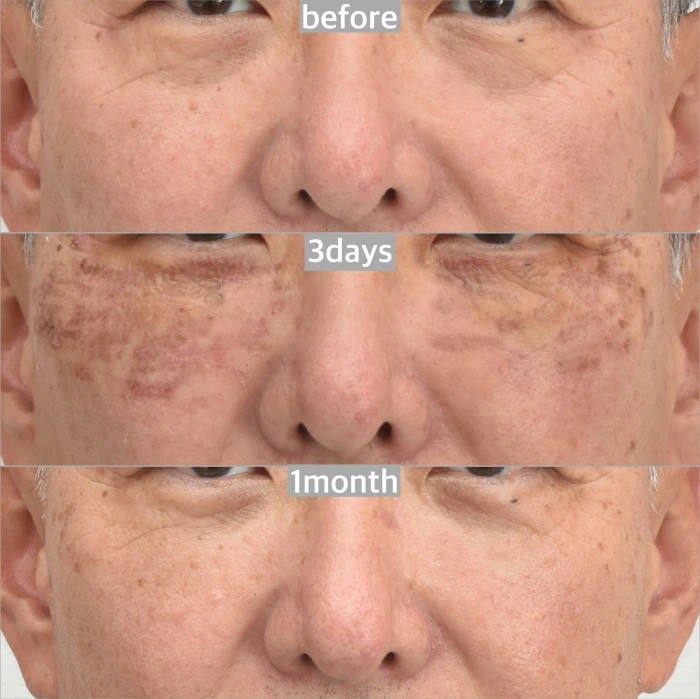 结合眼袋重塑与纳米剥脱激光的术前术后对比。规范术后护理下的激光换肤卓越成效。