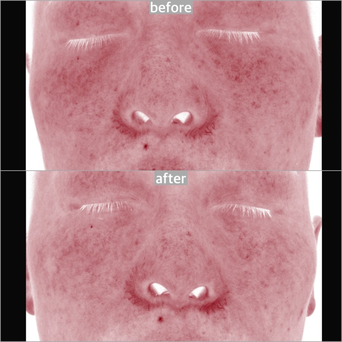 حقن الدهون تحت العين