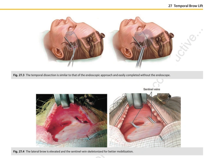 Medical diagram of standard temporal brow lift technique