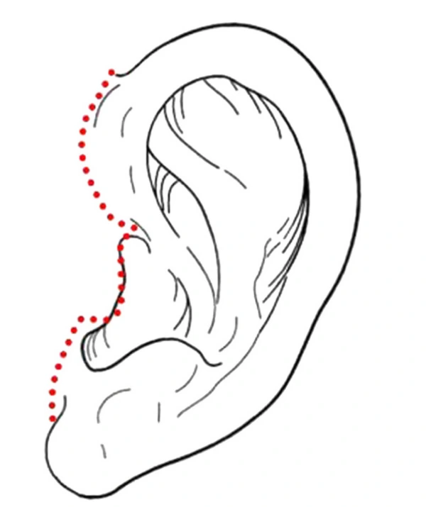 why is it better to do posterior tragus incision in facelift