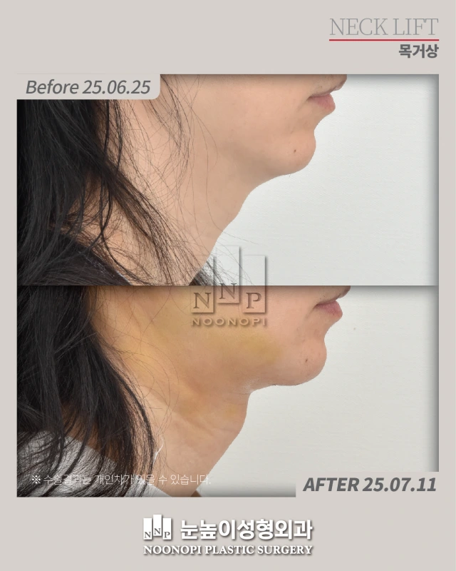 Before and after a full neck lift for turkey neck and sagging neck skin