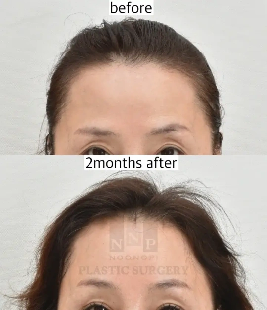 Late postoperative swelling after endoscopic brow lift
