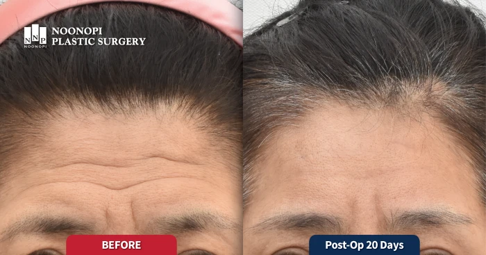 Combination treatment of forehead lift and laser resurfacing for deep static wrinkles