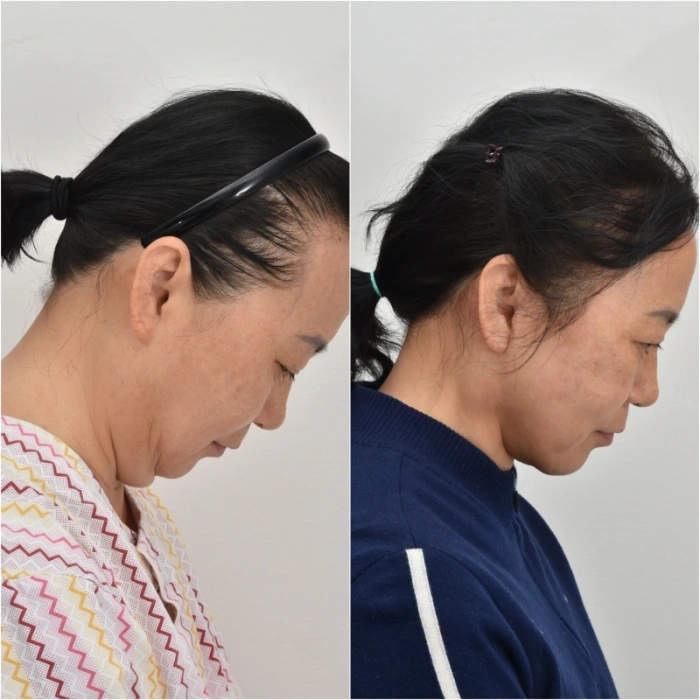 نتائج شد الوجه وشد الرقبة مع تصغير الغدة تحت الفك السفلي