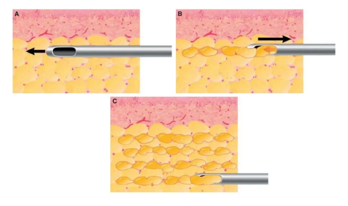 The Secret to Successful Fat Graft Survival