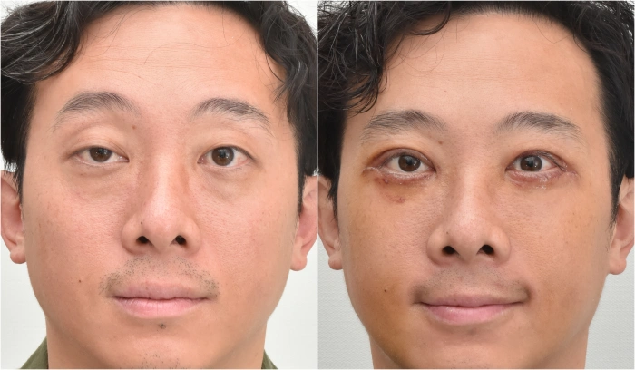 不对称垂垂眼手术前后对比（术后1周）