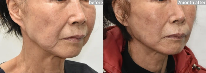 revision Facelift before after korea