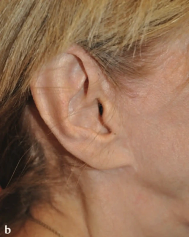 earlobe attached after facelift