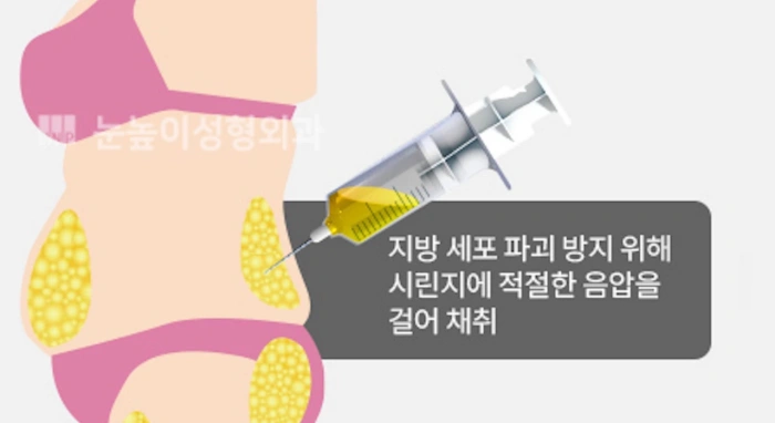 지방 채취시 주사기 음압 정도에 신경써야 한다