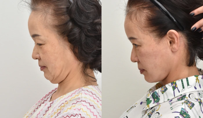칼귀교정 안면거상