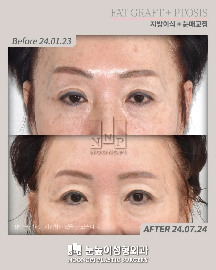Before and after case of upper eyelid surgery and temple fat grafting