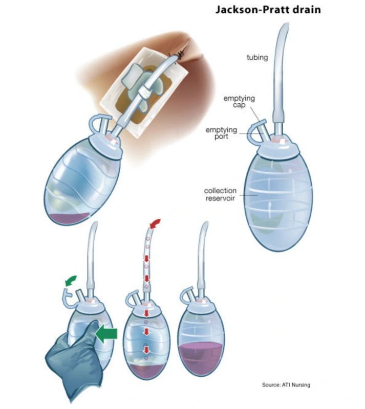 hemovac drain