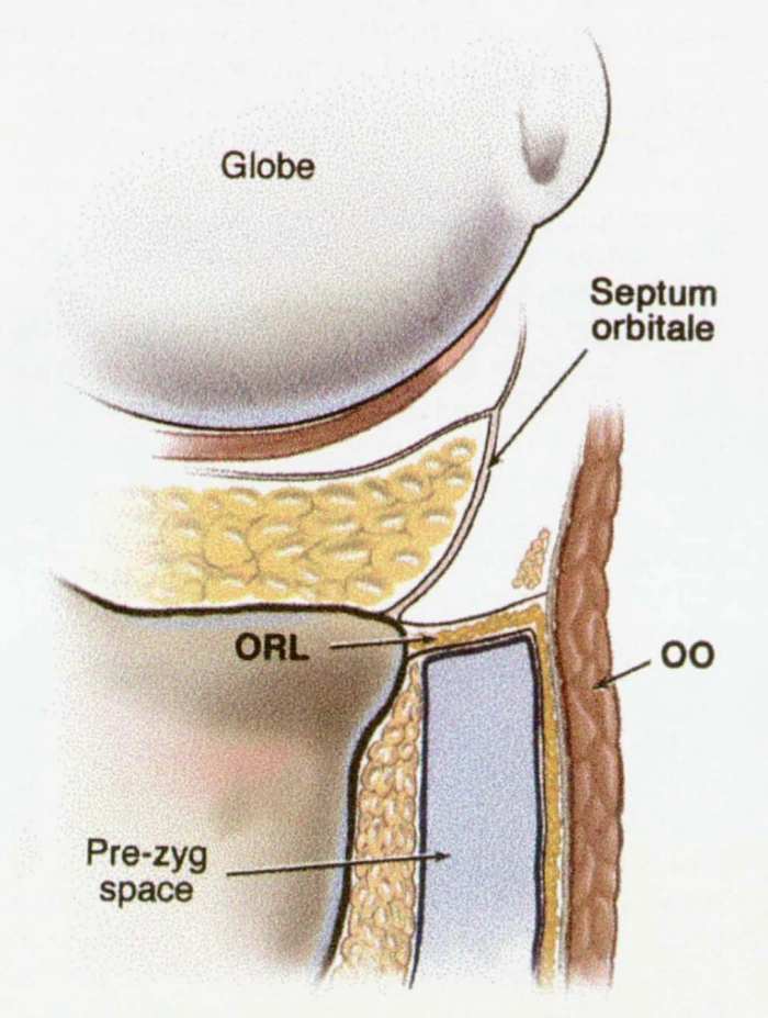An anatomical illustration showing the orbital retaining ligament and its location in the tear trough