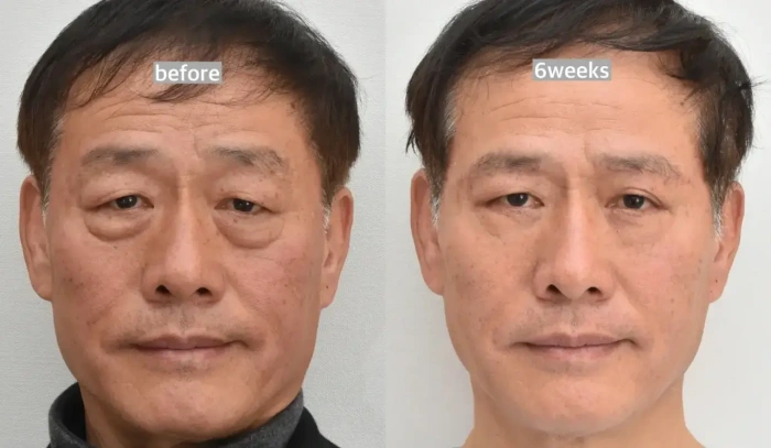 رفع الحاجبين في كوريا