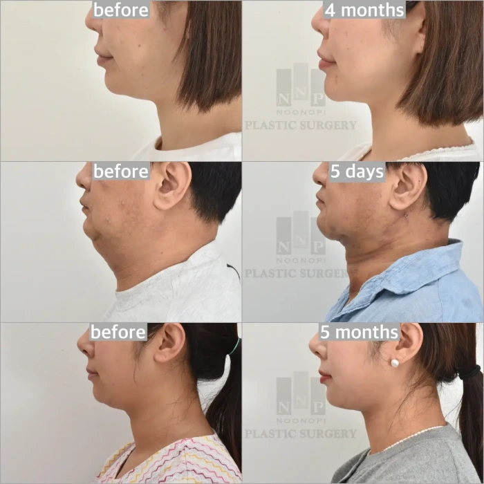 mini neck lift before after photos