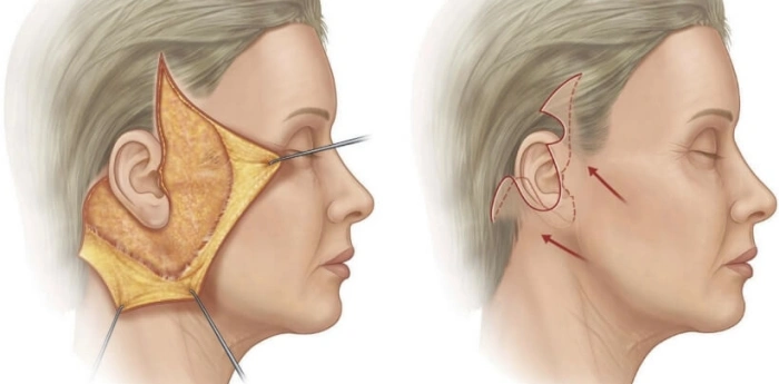 شق جانبي يتبعه تشريح الجلد وشده