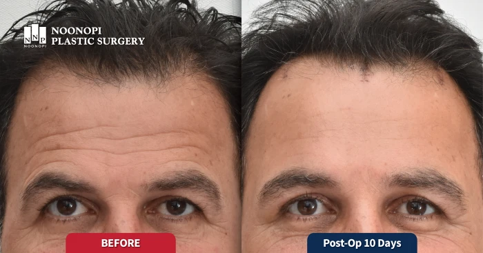 Before and after of a 60-year-old male patient showing dramatic wrinkle reduction with forehead lift only