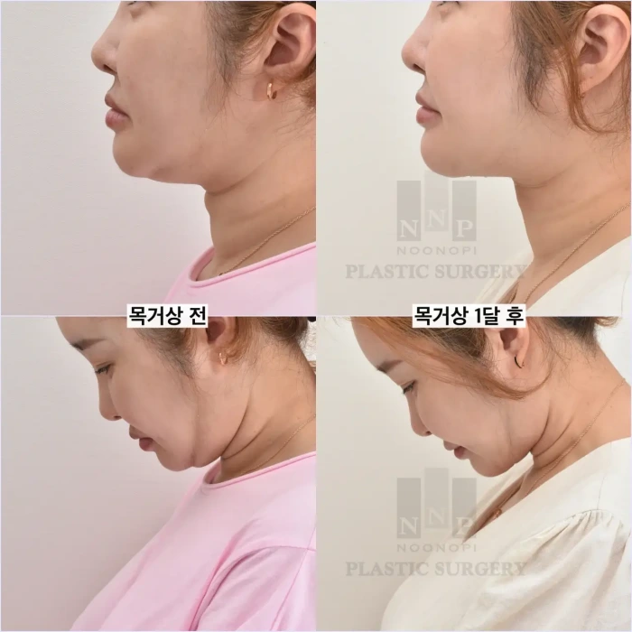 목거상술 후기