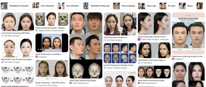 Asian facial bone reduction surgery for a smaller face