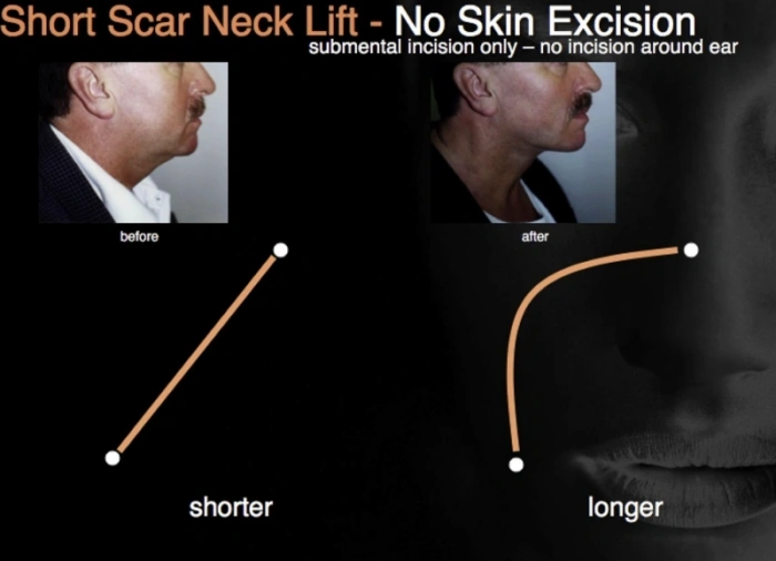 颈部手术后皮肤变化