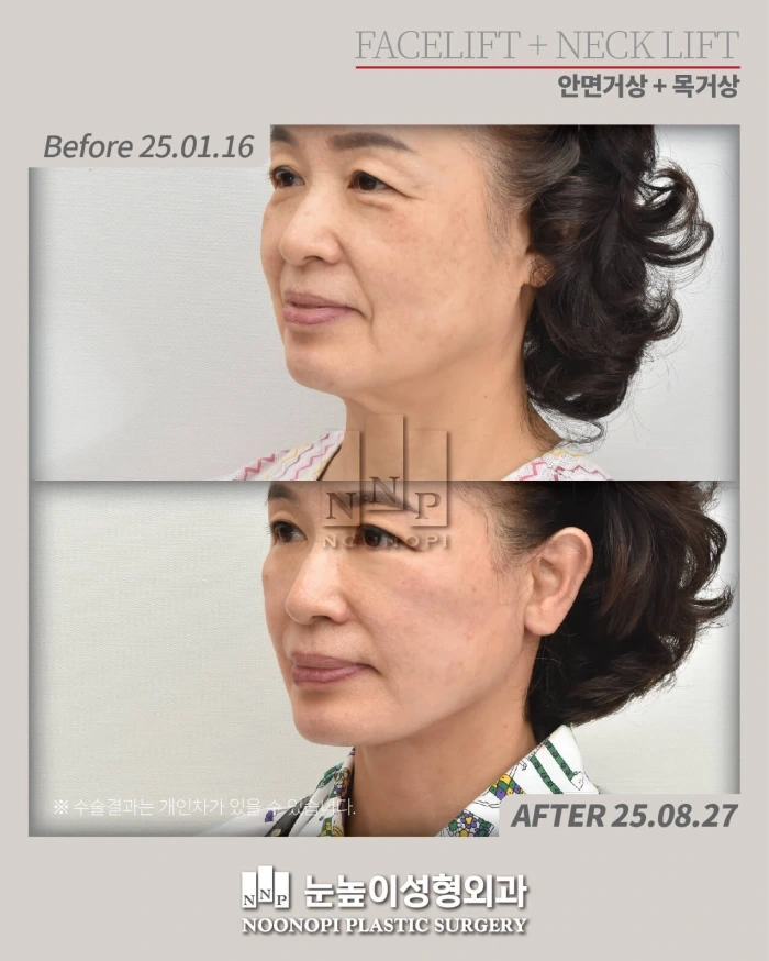 面颈提升术后7个月