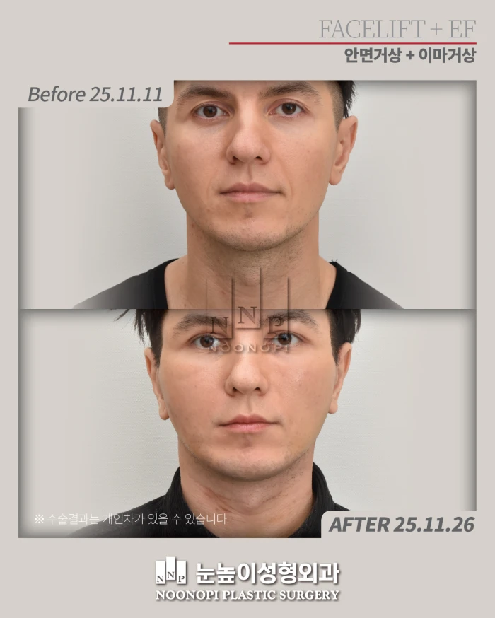 30대 안면거상 15일 후 모습