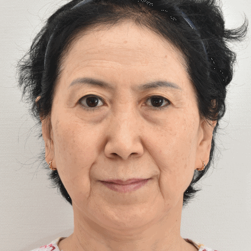 شد الحاجب الداخلي، حقن الدهون في الجفن العلوي والسفلي، شد الجفن السفلي: 3 أشهر