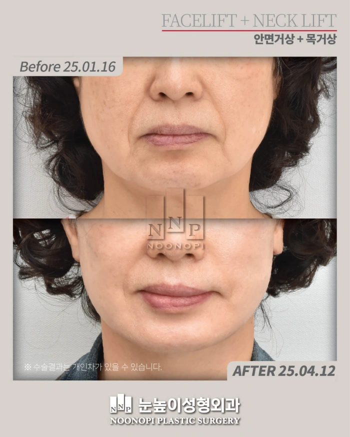 deep plane facelift korea