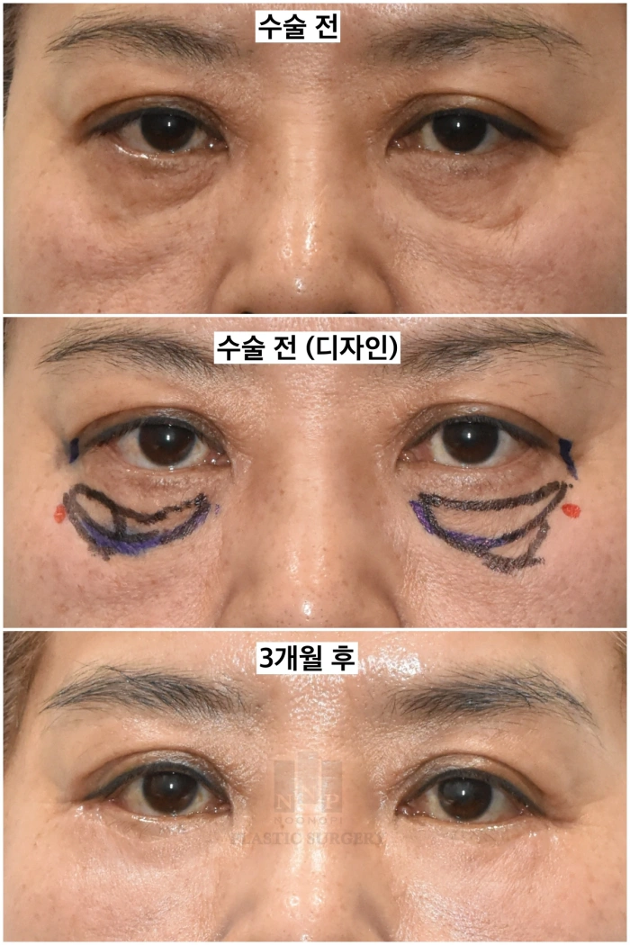 하안검 재수술 눈밑 지방이식 전후