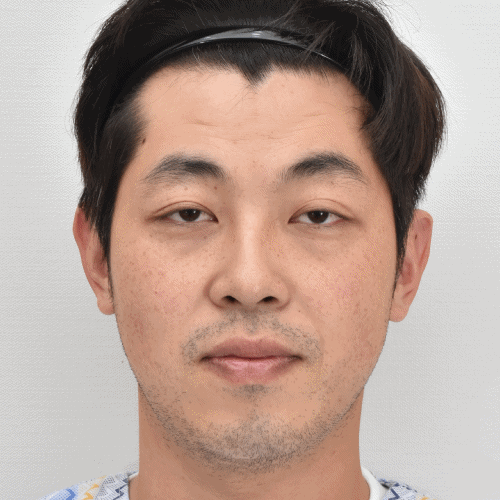 双侧眼睑下垂矫正术前术后对比