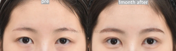 切开法术后一个月内趋于自然