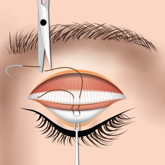 sleepy eyelid surgery process illustration