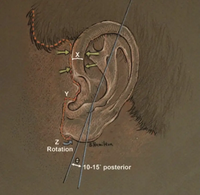 耳垂方向指导原则
