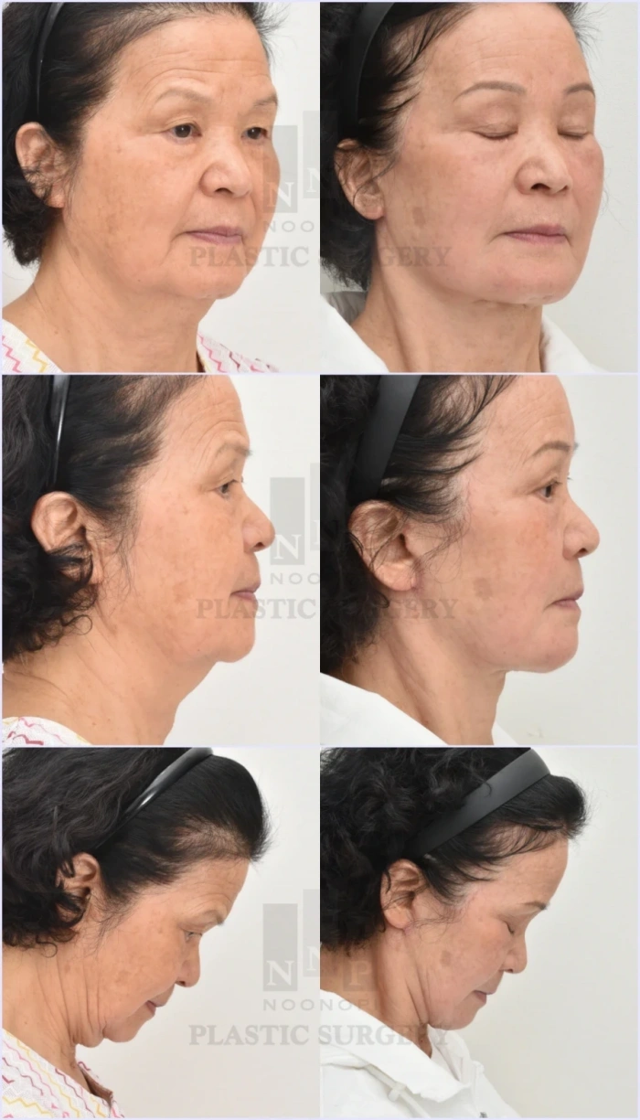 자연스러운 귀 모양을 유지한 눈높이 안면거상술 특징